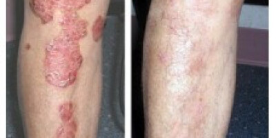 AROGYAM PURE HERBS KIT FOR PSORIASIS Psoriasis is a skin disorder in which patient is disturbed