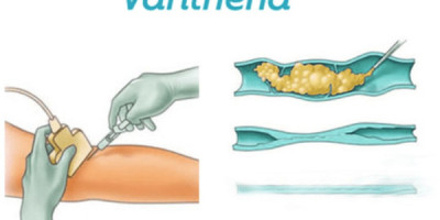What to Expect During Your First Varithena Treatment in Maryland?