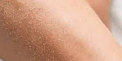 Xerosis Dry Skin Treatment NYC Top Professional Solutions for Hydrated Skin